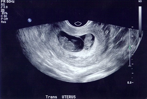 An ultrasound of twins.