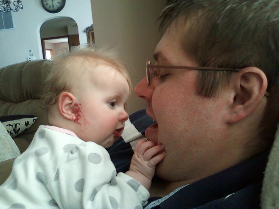 liney hemangioma side view on an infant's head