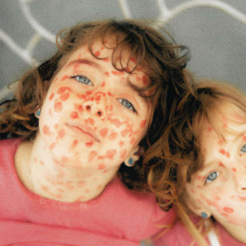I Was Four Years Old When Measles Collapsed My Left Lung